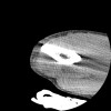SPORK, NICO - 22.03.1976 - 02.08.2022 - CT obere Extremität - 17:51:17